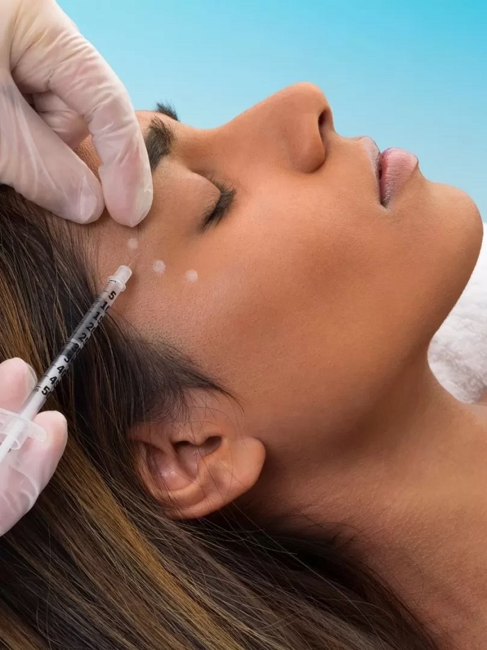 Xóa nhăn đuôi mắt bằng botox