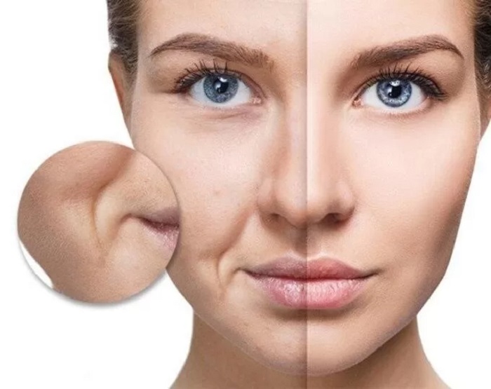 Xóa rãnh cười tại nhà