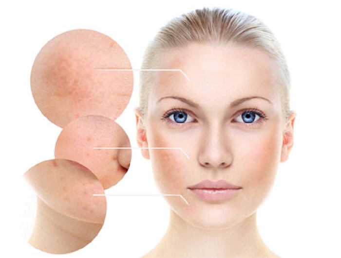 Bị nám có nên dùng retinol Bị nám có nên dùng retinol