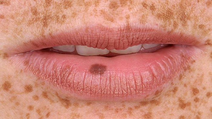 Bị nám quanh miệng Bị nám quanh miệng