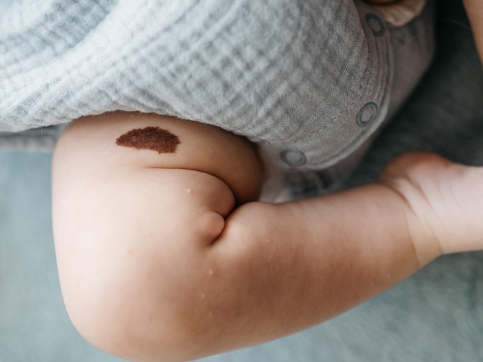 Bớt bẩm sinh trên cơ thể Bớt bẩm sinh trên cơ thể