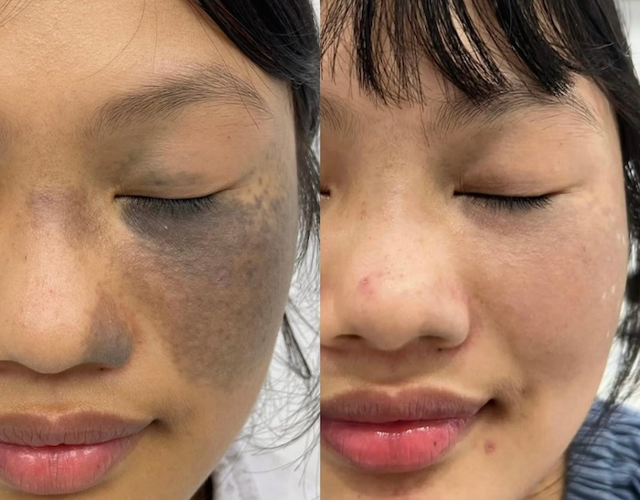 Bớt bẩm sinh trên mặt