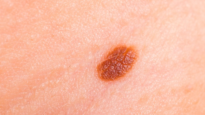 Bớt thượng bì bẩm sinh