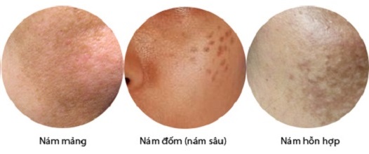 Các loại nám phổ biến Các loại nám phổ biến