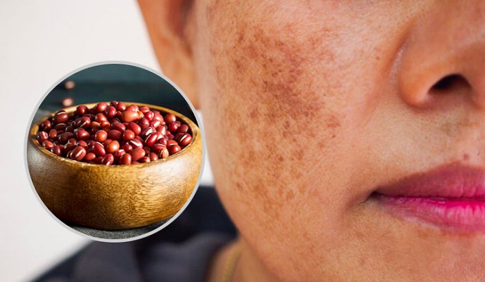 Cách trị nám bằng bột đậu đỏ