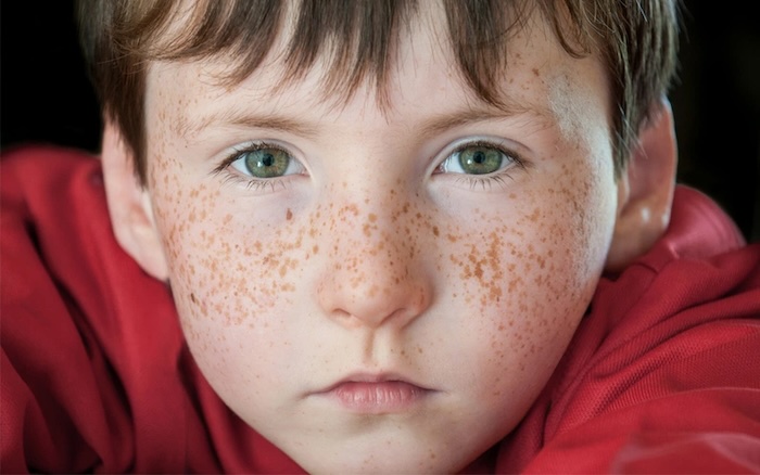 Cách trị nám cho trẻ em Cách trị nám cho trẻ em