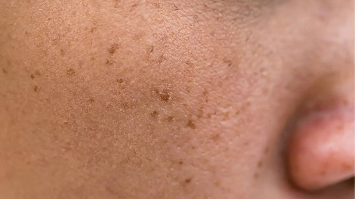 Cách trị nám đốm nâu Cách trị nám đốm nâu