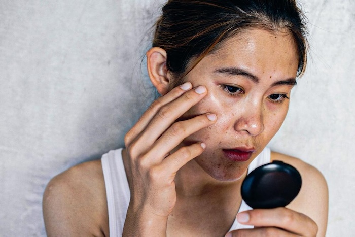 Cách trị nám mới xuất hiện