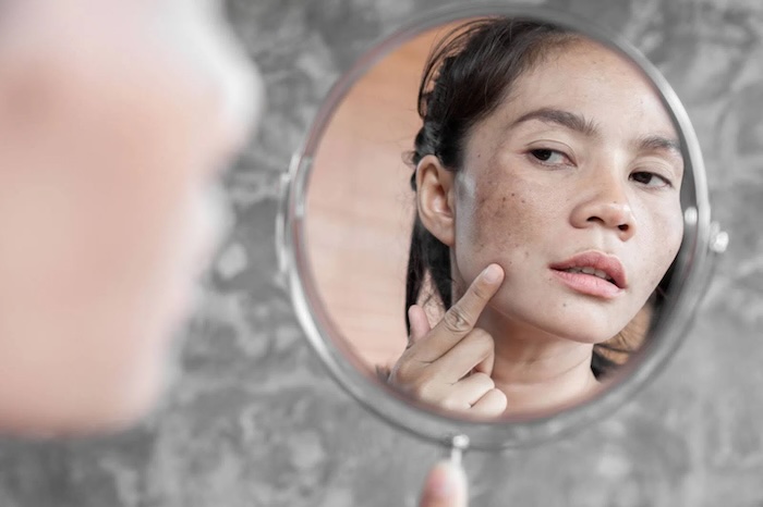 Cách trị nám nặng