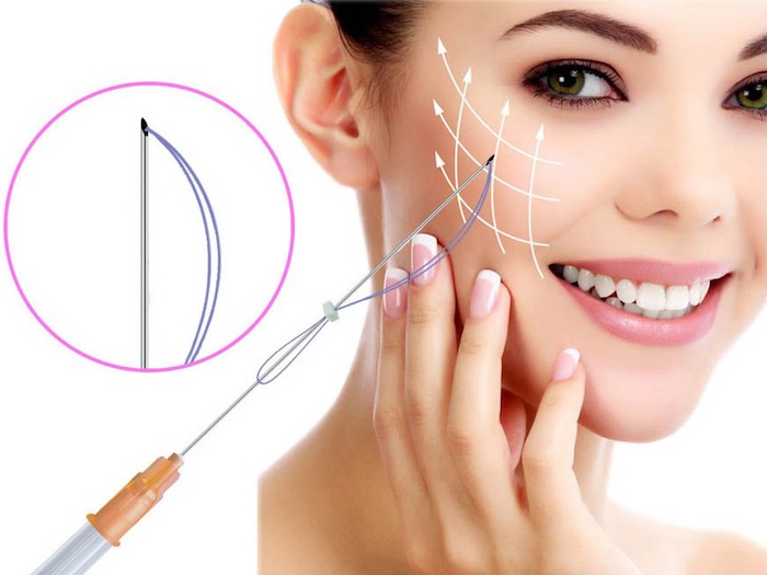 Cấy chỉ căng da mặt