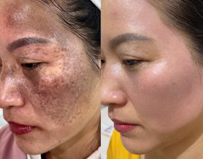Chàm đỏ bẩm sinh