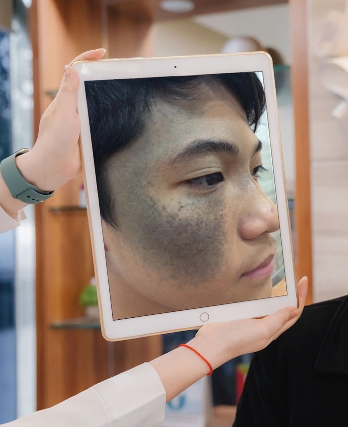 Chữa bớt đen bẩm sinh Chữa bớt đen bẩm sinh