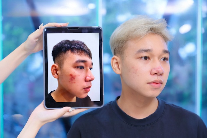 Chữa chàm đỏ bẩm sinh