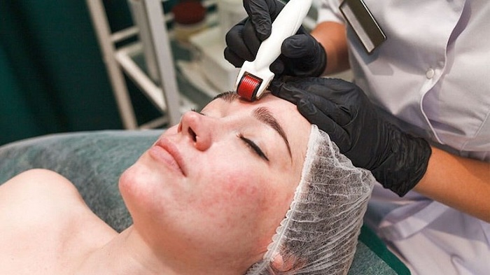 Có nên lăn kim trị nám không Có nên lăn kim trị nám không