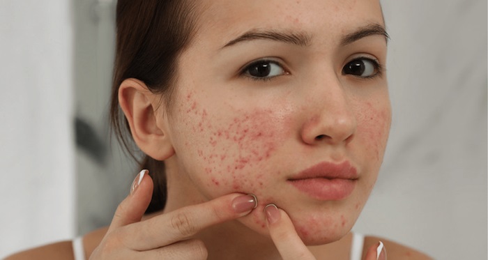 Da mặt bị nám trị gì hết Da mặt bị nám trị gì hết