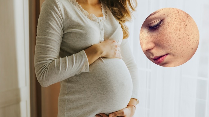 Dấu hiệu nám da khi mang thai Dấu hiệu nám da khi mang thai