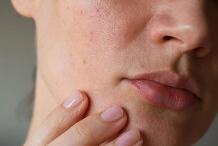 Điều trị bớt bẩm sinh ở đâu Điều trị bớt bẩm sinh ở đâu