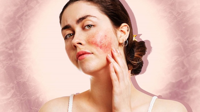 Điều trị bớt đỏ bẩm sinh