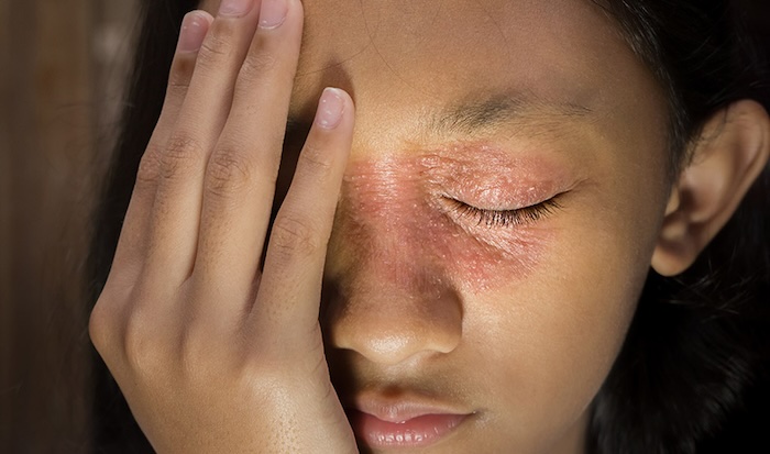 Điều trị bớt sắc tố bẩm sinh