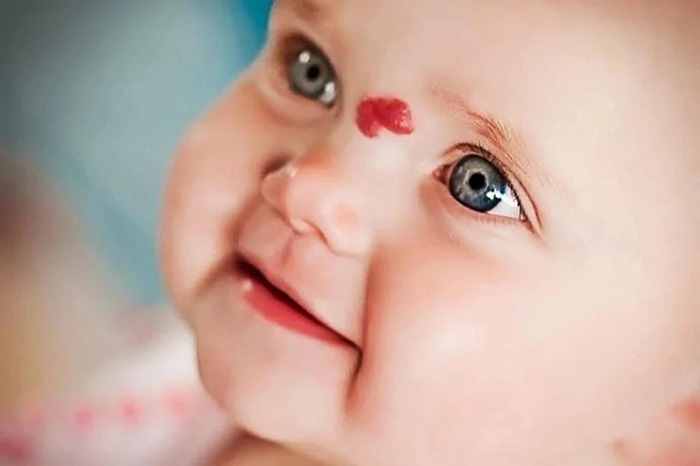 Điều trị chàm đỏ bẩm sinh