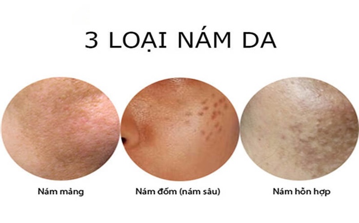 Hiện tượng nám da mặt