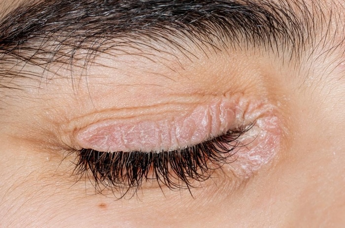 Kem trị thâm mắt bẩm sinh