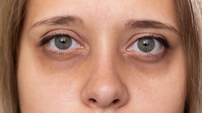 Kem trị thâm mắt image Kem trị thâm mắt image