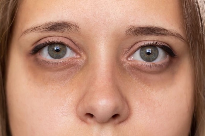 Kem trị thâm quầng mắt eye cream