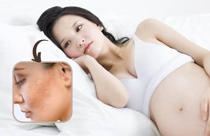 Nám da khi mang thai Nám da khi mang thai