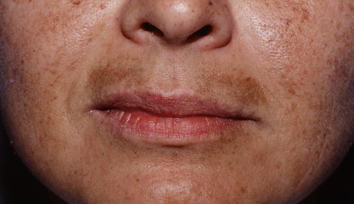 Nám hàm râu Nám hàm râu