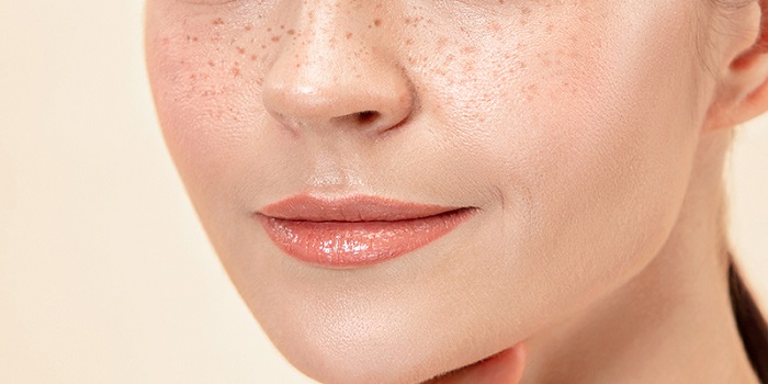 Nám là gì Nám là gì