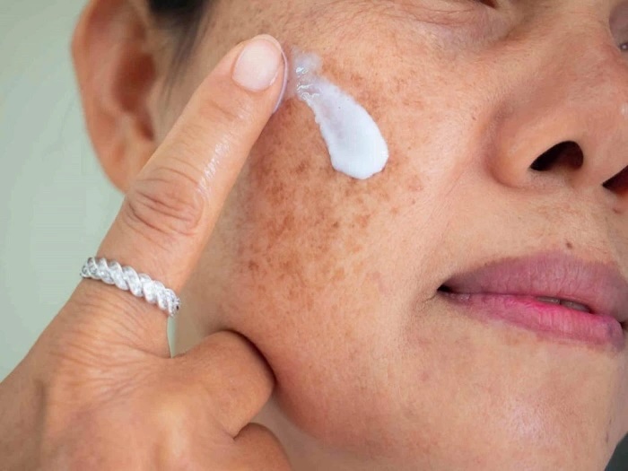 Ốc sên trị nám