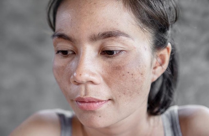 Ốc sên trị nám
