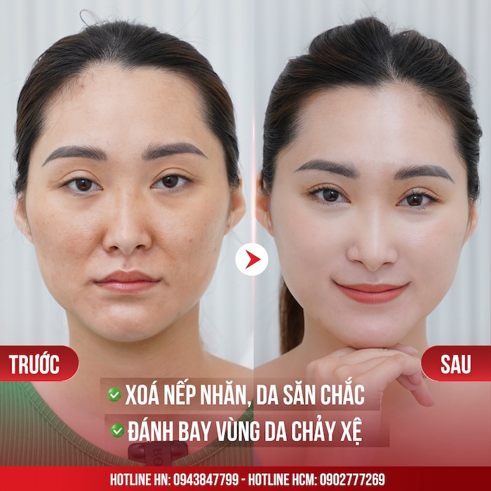 Sản phẩm nâng cơ mặt gcoop Sản phẩm nâng cơ mặt gcoop