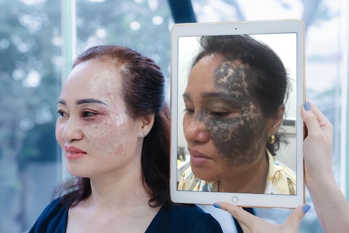 Tẩy chàm bẩm sinh