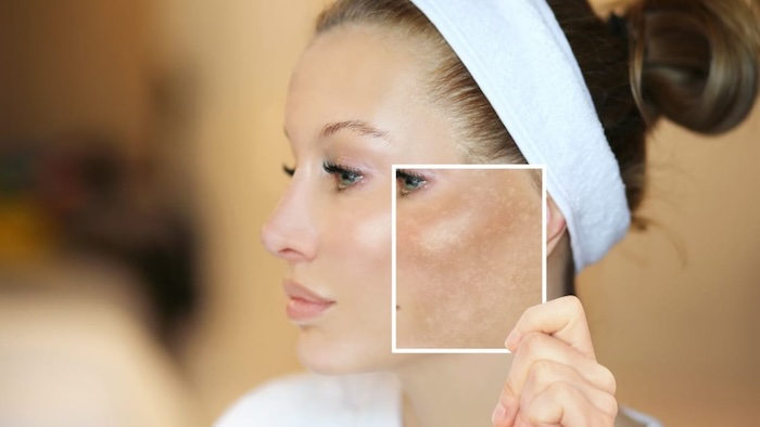 Tế bào gốc đặc trị nám Tế bào gốc đặc trị nám