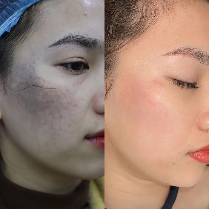 Trị chàm bẩm sinh