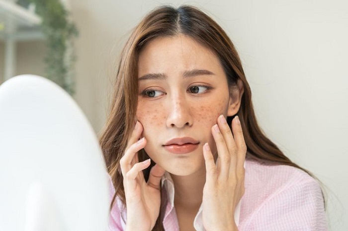 Trị nám bằng gạo lứt