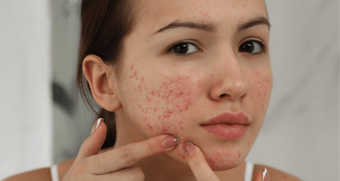 Trị nám bằng giấm táo