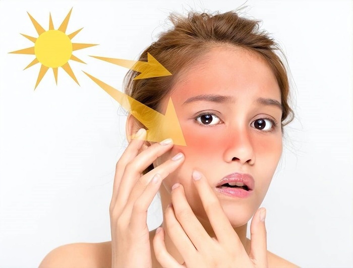 Trị nám bằng lá lốt