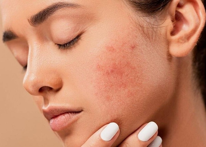 Trị nám bằng nước vo gạo