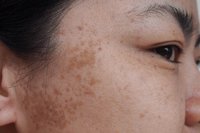 Trị nám hỗn hợp