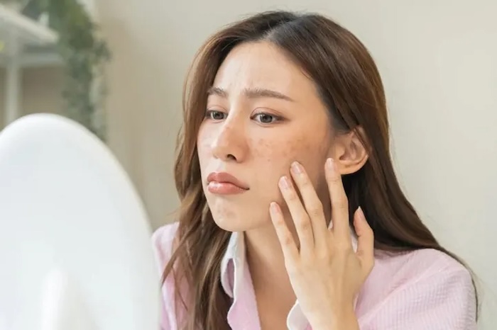 Trị nám nhẹ