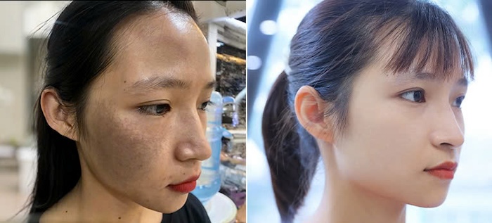Trị vết chàm bẩm sinh