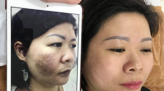 Xóa bớt bẩm sinh