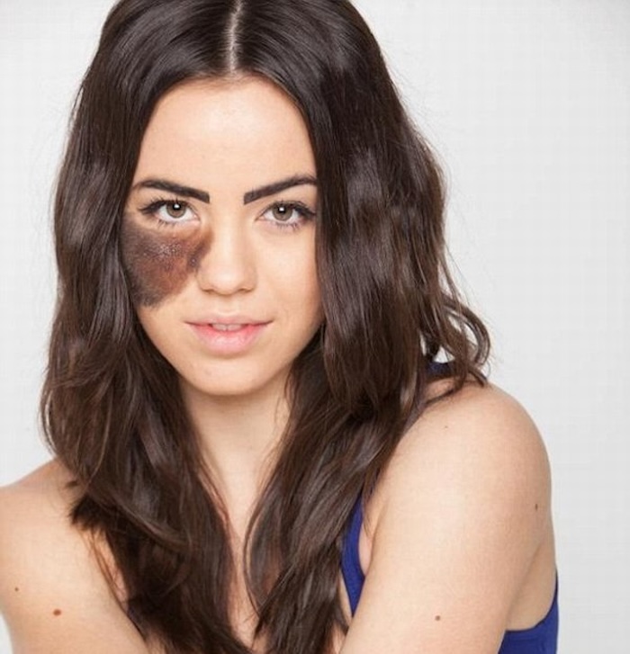 Xóa bớt bẩm sinh ở đâu