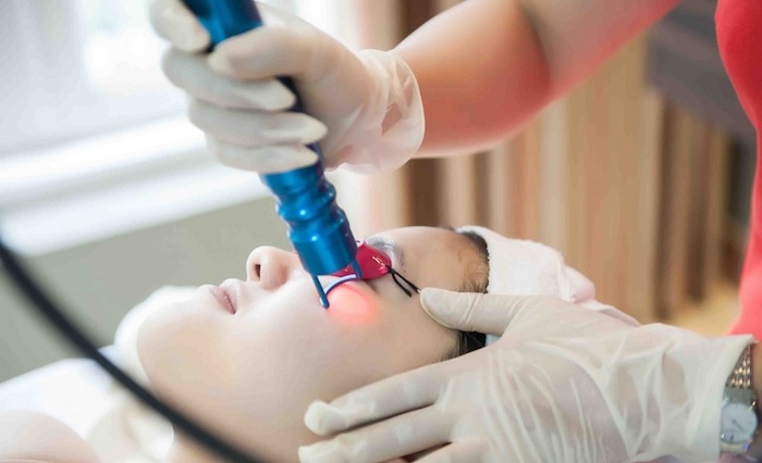 Xóa chàm bằng laser