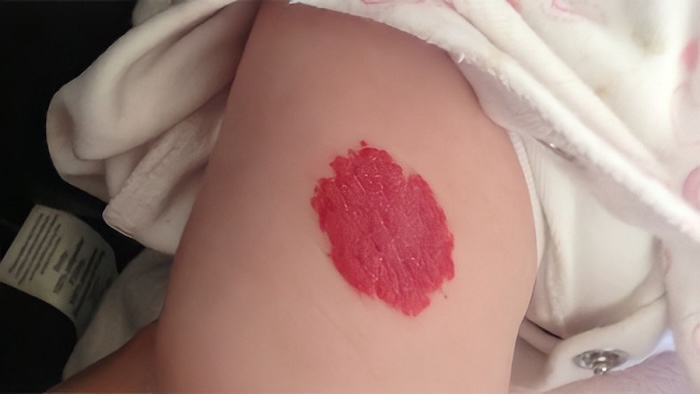 Xóa vết chàm đỏ Xóa vết chàm đỏ