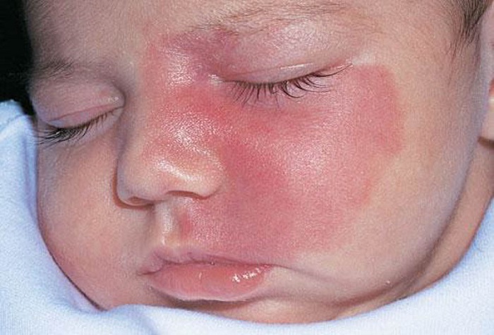 Xóa vết chàm đỏ cho bé sơ sinh