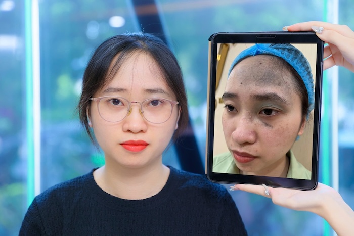 Xóa vết chàm xanh